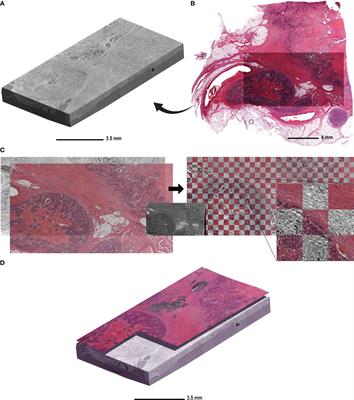 X-ray phase-contrast 3D virtual histology characterises complex tissue architecture in colorectal cancer